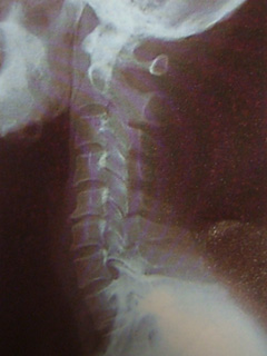 ストレートネック